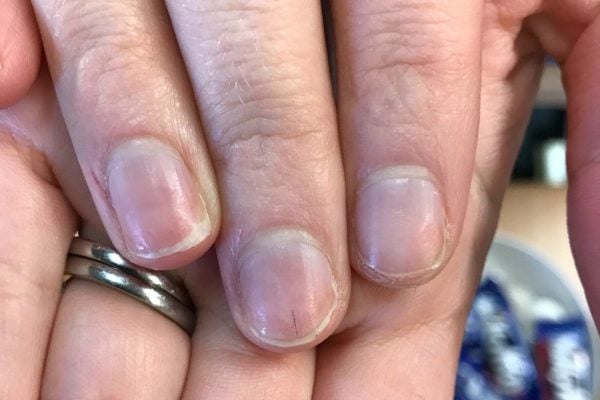 Nails and health